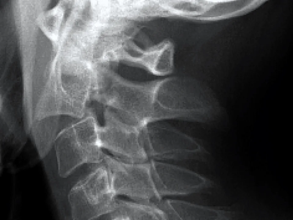 C-spine · lateral