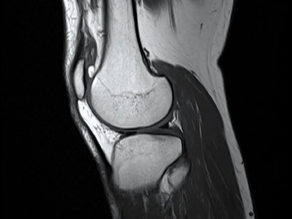 Knee MRI · sagittal T1
