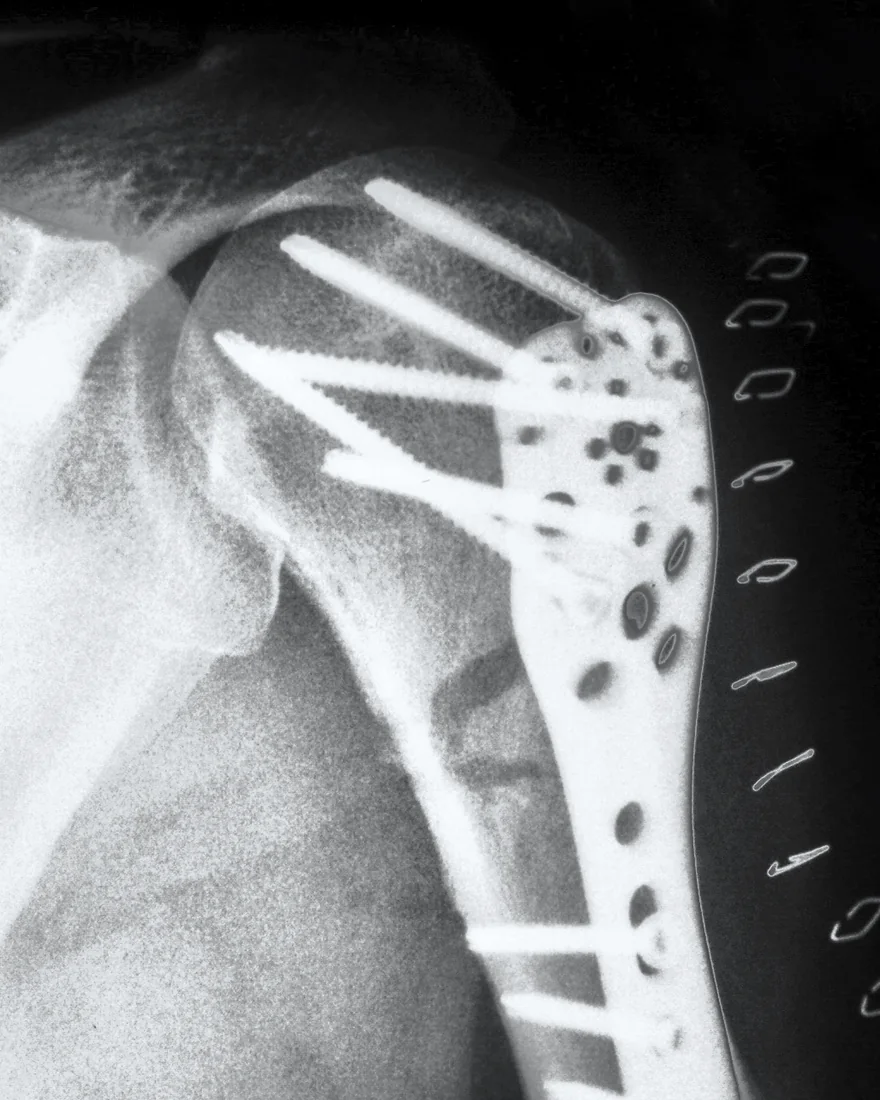 Shoulder · AP