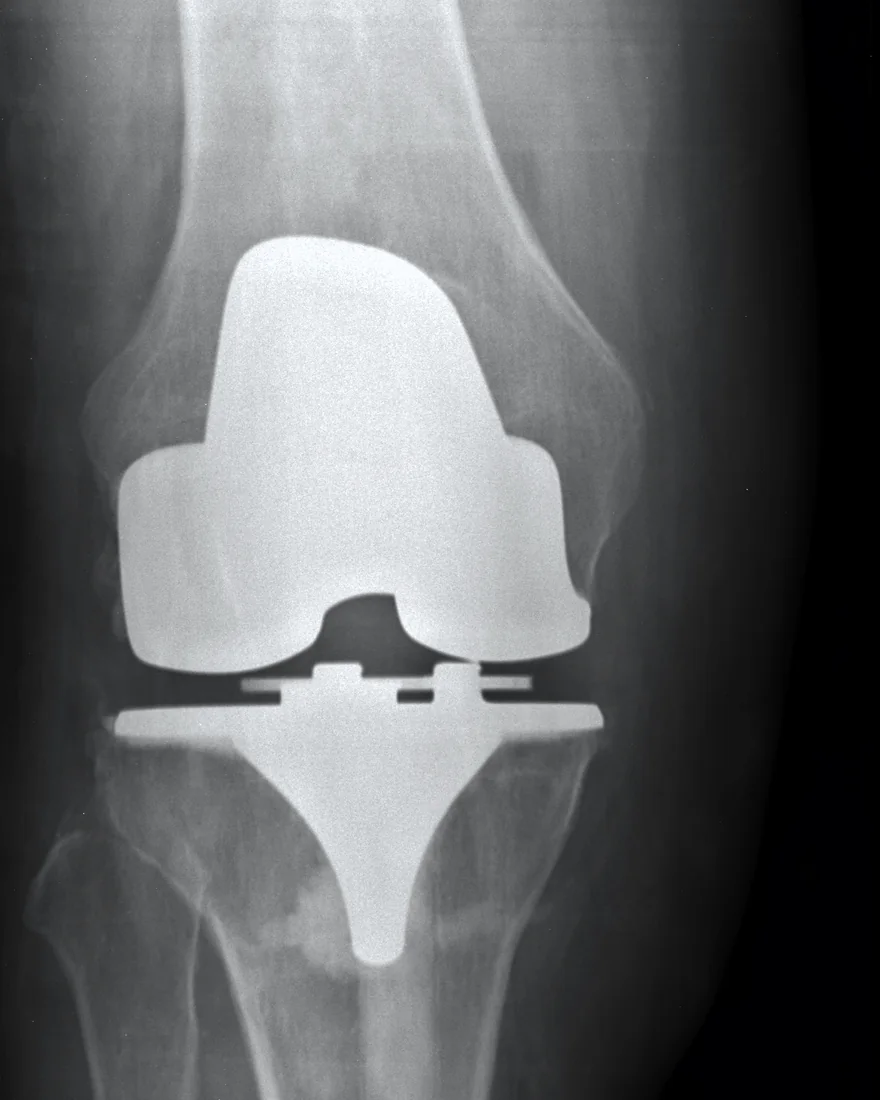 Knee replacement · AP